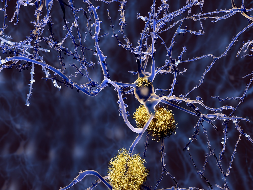 Alzheimers disease, neuron with amyloid plaques, illustration